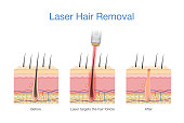 istock Laser hair removal at the skin layer and follicle for beauty and smoothness. Medical diagram before and after use laser get rid hair. 1373058464