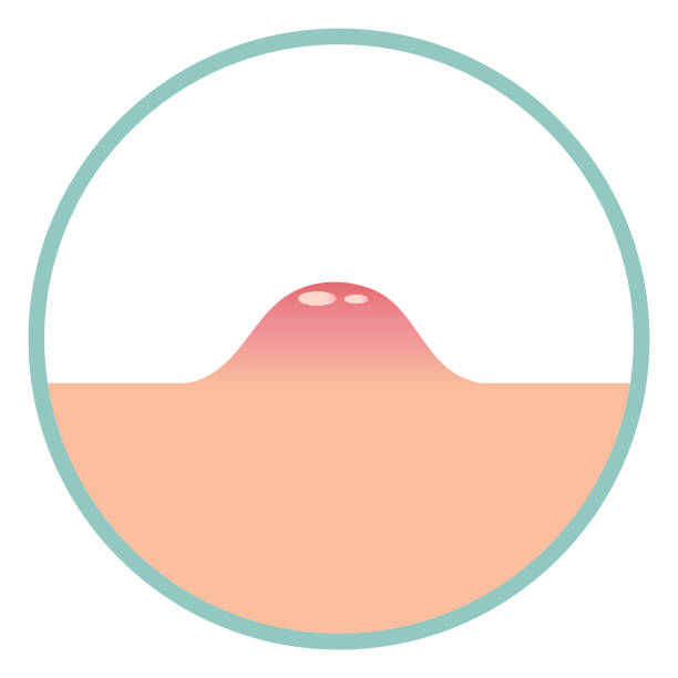 A pimple rises above the skin, circle illustration. A pimple rises above the skin, circle illustration. Purulent inflammation on the surface of the skin. Vector illustration, flat minimal color cartoon design, isolated on white background, eps 10. abscess stock illustrations