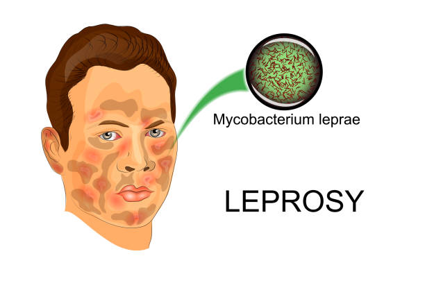 the face of the patient suffering from leprosy illustration of person sick suffering from leprosy and the agent of this disease under the microscope"r"n leprosy stock illustrations