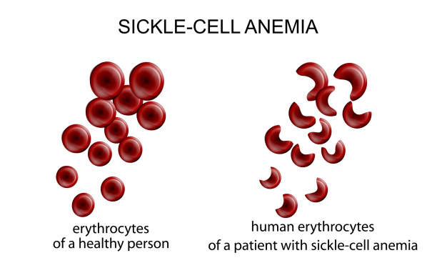 sichelzellenanämie - sickle cell anemia red blood cell blood cell anemia stock-grafiken, -clipart, -cartoons und -symbole