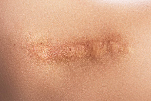 weibliche schulter mit narbe nach der operation - scar stock-fotos und bilder