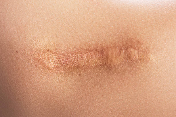 Female shoulder with a scar after surgery Close-up of female shoulder with a scar after surgery scar stock pictures, royalty-free photos & images