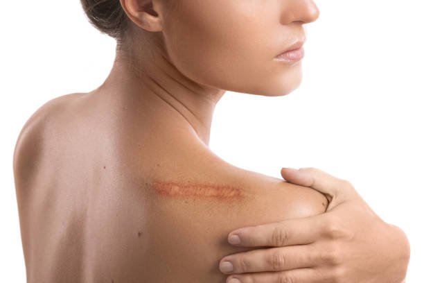 Woman with a scar on her shoulder Woman with a scar on her shoulder over white background scar stock pictures, royalty-free photos & images