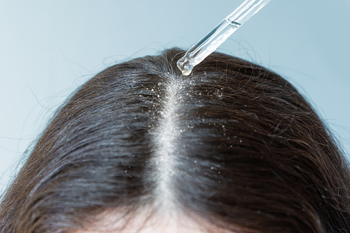 Primer plano de una cabeza femenina con cabello oscuro. Una pipeta con un producto cosmético cerca de la separación del cabello. El concepto de caspa photo