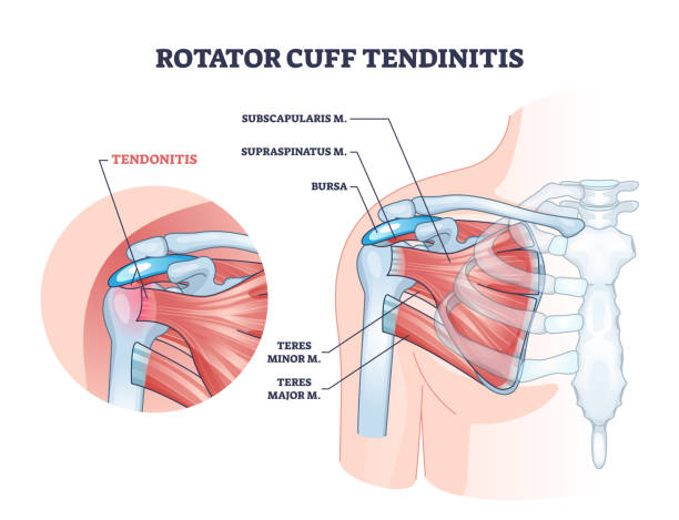 ilustraciones, imágenes clip art, dibujos animados e iconos de stock de tendinitis del manguito rotador como diagrama de contorno de inflamación muscular del hombro - rotator cuff