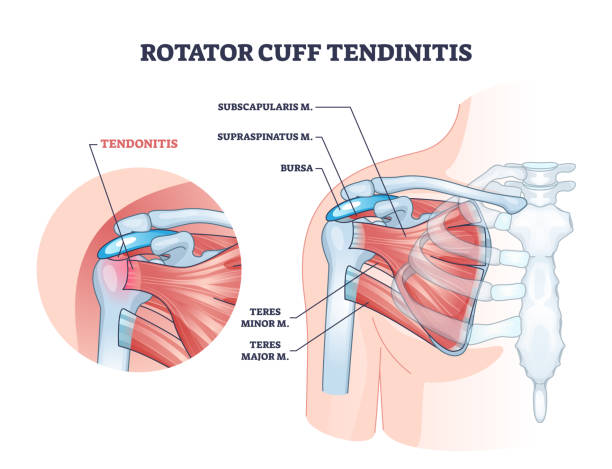 тендинит ротаторной манжеты как схема мышечного воспаления плеча - rotator cuff stock illustrations