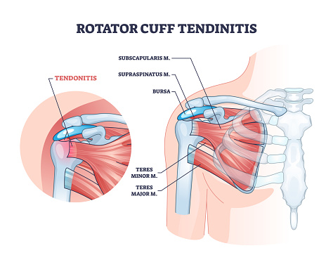 Rotator cuff tendinitis as shoulder muscular inflammation outline diagram. Labeled educational anatomical structure and medical description with body muscle injury and pain cause vector illustration.
