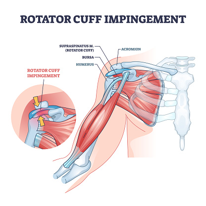 Rotator cuff impingement and anatomical shoulder muscle outline diagram. Labeled educational muscular and skeletal description with injury example vector illustration. Supraspinatus body part location