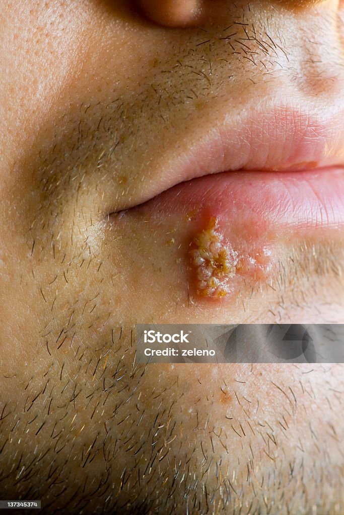 Close-up photograph of cold sores herpes labialis Herpes labialis or "orolabial herpes"  is an infection of the lip by herpes simplex virus. An outbreak typically causes small blisters or sores on or around the mouth commonly known as cold sores or fever blisters. The sores typically heal within 2–3 weeks, but the herpes virus remains dormant in the facial nerves, following orofacial infection, periodically reactivating (in symptomatic people) to create sores in the same area of the mouth or face at the site of the original infection. Cold Sore Stock Photo