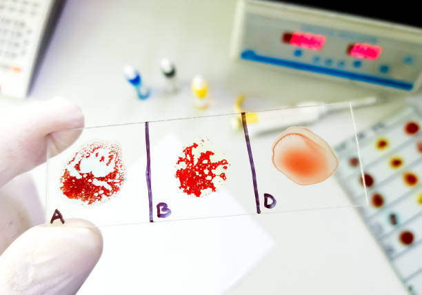 AB negative rare Blood group testing by slide agglutination stock photo