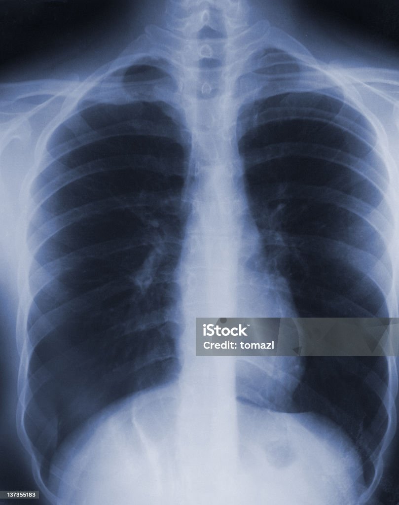 흉부 X선 검사 - 로열티 프리 엑스레이 이미지 스톡 사진