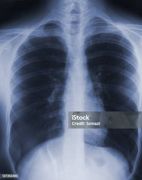 Foto de Peito Xray e mais fotos de stock de Imagem de raios X - Imagem de raios X, Peito, Costela - Osso Humano