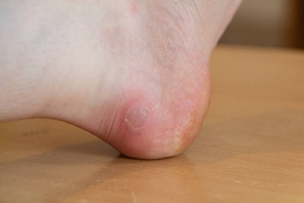 istock Wound after a blister on the foot 1373688952