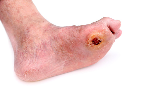 A photograph of a senior woman's calloused and ulcerated diabetic foot.  This patient is dealing with an ulcer on this foot for the second time.  High blood sugar affects nerves and blood vessels in the feet, causing them to lose their ability to function properly. Damage to the blood vessels and nerves takes away feeling putting them at a higher risk for trauma. This patient did not feel the first ulcers on the bottom of her foot until it was too late. Extreme infection had set in and antibiotics were ineffective. Parts of the bone in her foot were removed and replaced with steel plates and the top portion of her second toe had to be amputated.  The patient is undergoing treatment for this new ulcer.