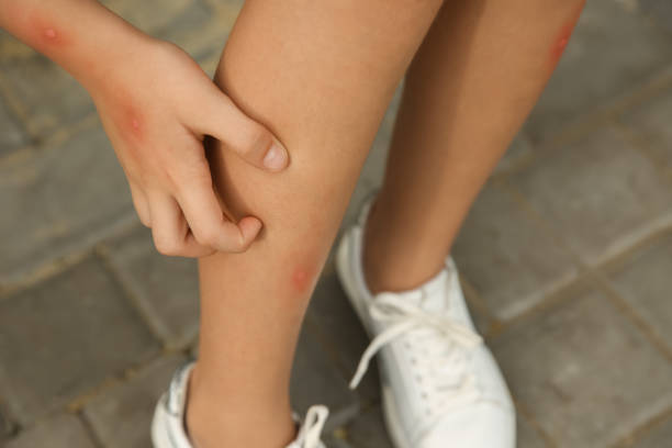 istock Girl scratching leg with insect bite outdoors, closeup 1374369970