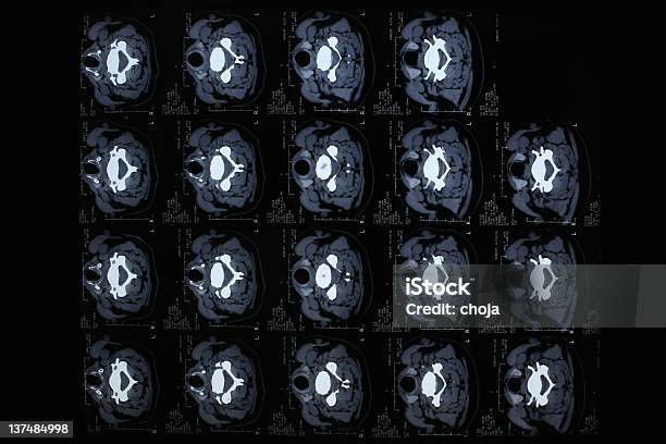 Foto de Tomografia Computadorizada De Espinal Medula Coluna e mais fotos de stock de Exame de ressonância magnética