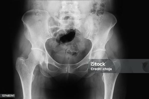 Xray Della Pelvi Umano - Fotografie stock e altre immagini di Anca - Anca, Apparato digerente umano, Bianco