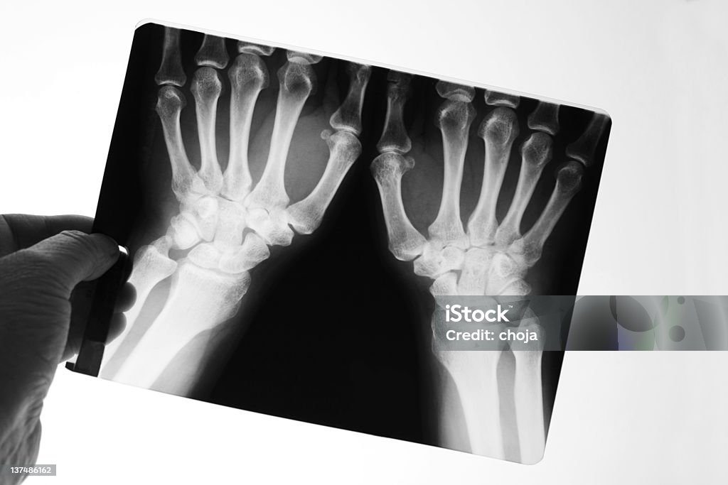 Radiografia della mano umana - Foto stock royalty-free di Artrite