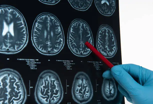 Photo of Doctors reviewing brain x-rays;MRI of the blood vessels in the brain and cerebrovascular disease or hemorrhagic stroke.