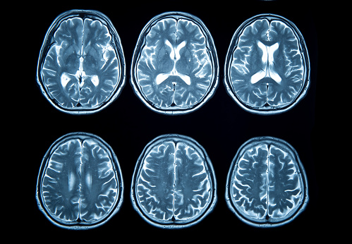 Brain stroke x-ray;MRI of the blood vessels in the brain and cerebrovascular disease or hemorrhagic stroke.