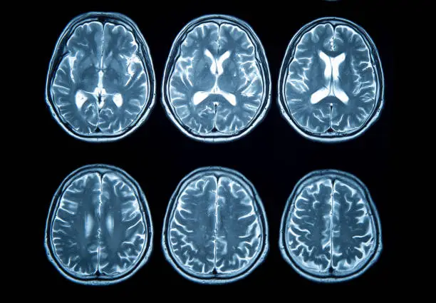 Photo of Brain stroke x-ray;MRI of the blood vessels in the brain and cerebrovascular disease or hemorrhagic stroke.