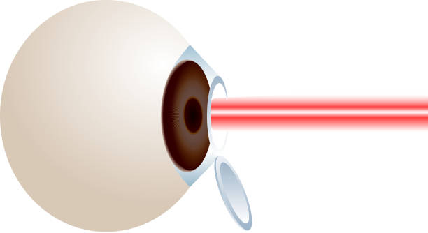 illustrations, cliparts, dessins animés et icônes de lasik chirurgie sur le contour des yeux - choroid