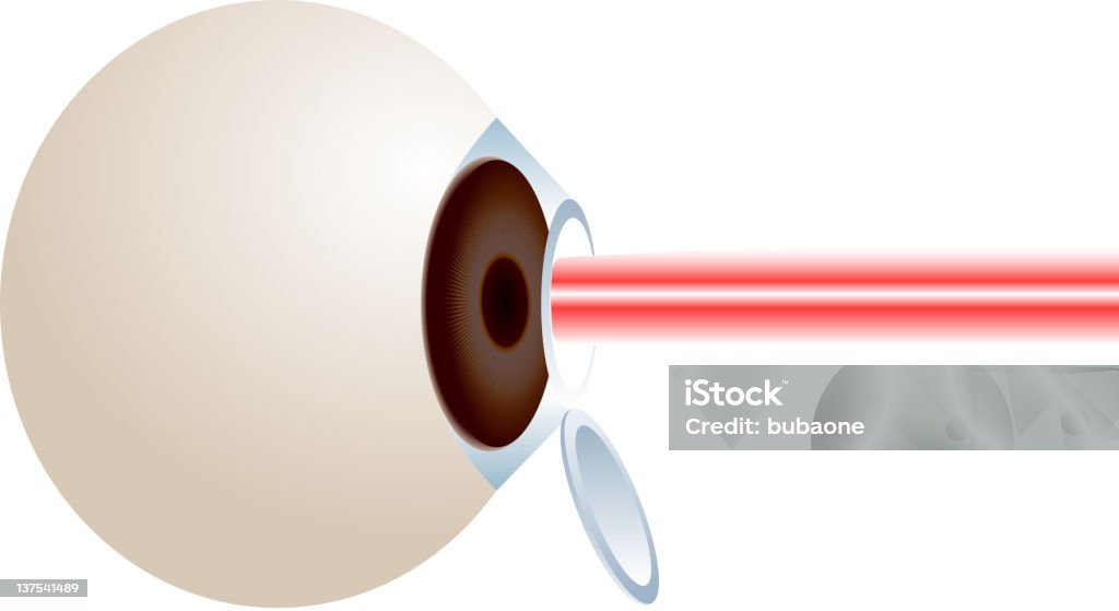 Lasik Surgery On The Eye Stock Illustration - Download Image Now - Eye  Surgery, Laser, Medical Laser - iStock