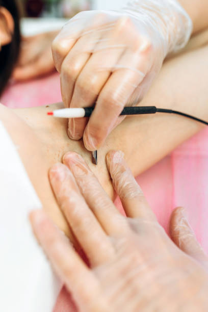 istock Procedure removal of hair permanently in a woman's armpits using metod electro epilation. Permanent removal of unwanted hair. The needle of electrolysis. Doctor in cosmetic medical cabinet. 1376105242