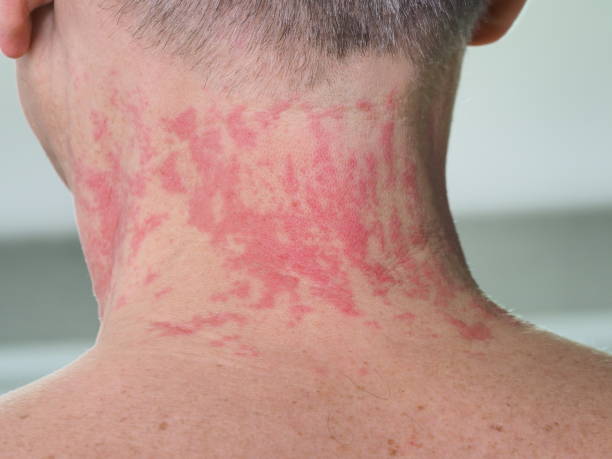 istock red spots allergy irritation on a man's neck 1376147454