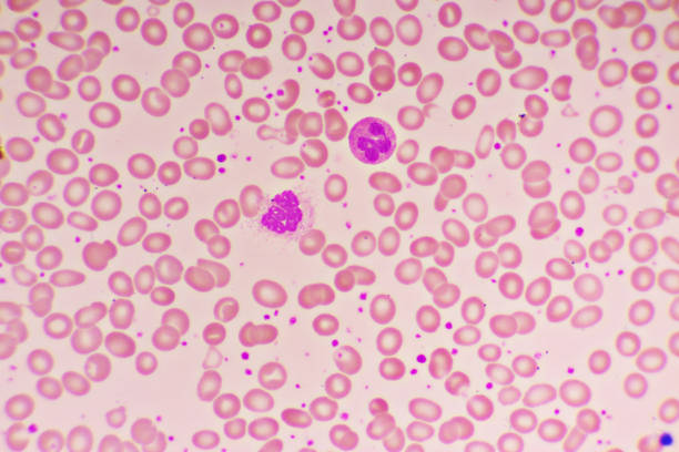 Essential thrombocytosis blood smear stock photo
