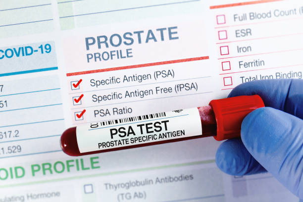Blood sample for analysis of PSA Prostate Specific Antigen profile test in laboratory stock photo