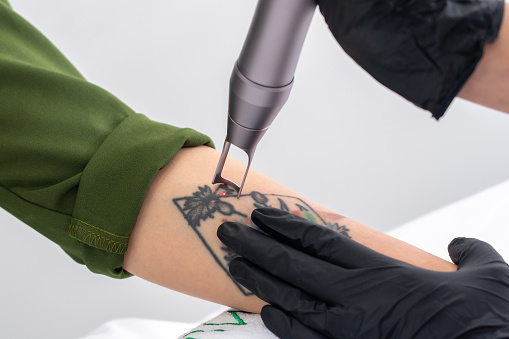 Cosmetólogo eliminando tatuaje con dispositivo láser mano femenina. Concepto de borrar tatuajes como un procedimiento costoso en la clínica de cosmetología photo