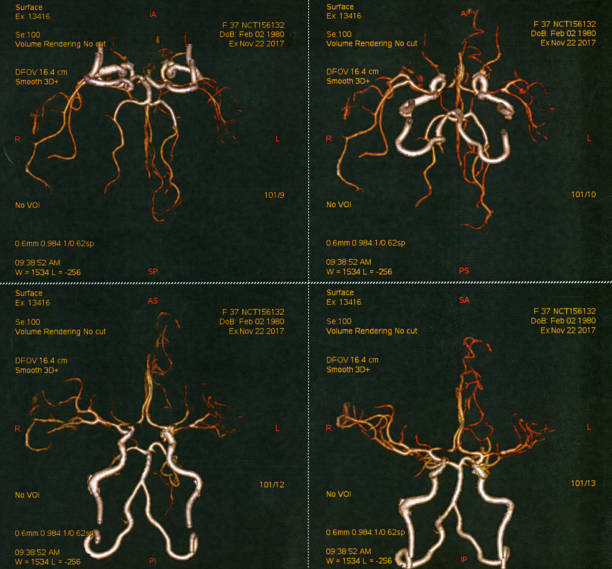 angiographie cérébrale humaine - mri scan human nervous system brain medical scan photos et images de collection