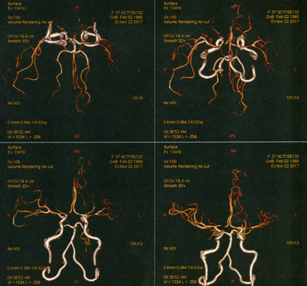 angiografia cerebral humana - mri scan human nervous system brain medical scan - fotografias e filmes do acervo