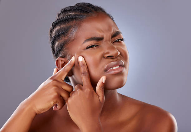 Shot of a young woman squeezing a pimple on her face They just pop up and ruin my day frowning headshot close up studio shot stock pictures, royalty-free photos & images