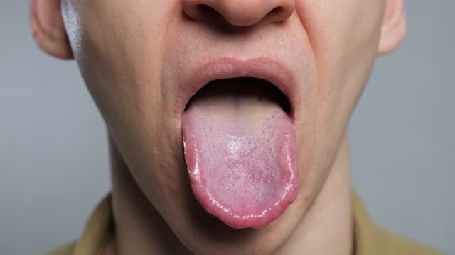 unrecognizable man shows infection tongue