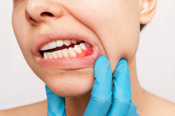 gum inflammation. a young woman's face with doctor gloved hand on her jaw showing red bleeding gums - gums imagens e fotografias de stock