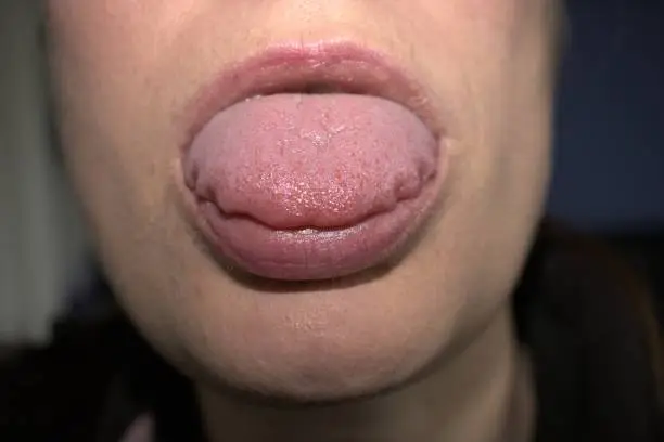 swollen enlarged white tongue with wavy ripple scalloped edges (medical name is macroglossia) and white lie bumps on tongue tip