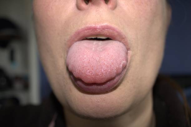 swollen enlarged white tongue with wavy ripple scalloped edges (medical name is macroglossia) stock photo