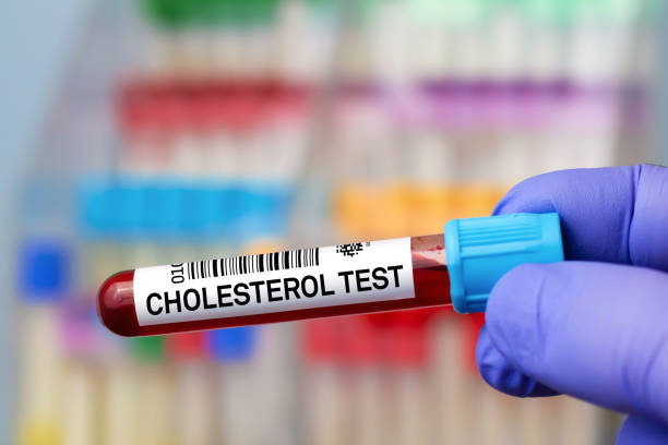 실험실에서 콜레스테롤 검사의 분석을 위한 환자의 혈액 샘플 - cholesterol 뉴스 사진 이미지