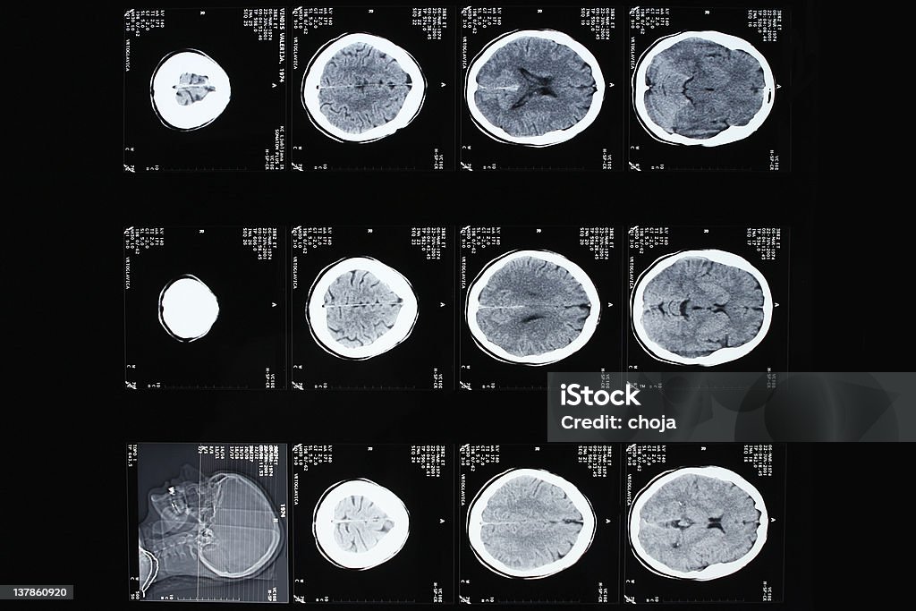 КТ-изображение человеческого мозга - Стоковые фото Магнитно-резонансная томография роялти-фри