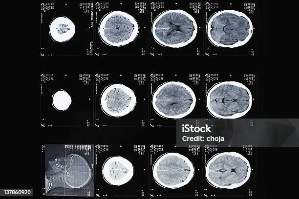Ктизображение Человеческого Мозга — стоковые фотографии и другие картинки Магнитно-резонансная томография - Магнитно-резонансная томография, Опухоль мозга, Раковая опухоль