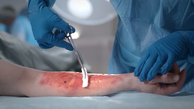Équipe de chirurgiens travaillant avec une plaie brûlée sur le bras du  patient en salle d’opération. Clip Vidéo 1379078096