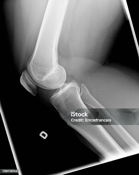 La Radiografía De La Rodilla Con Chondromalacia Foto de stock y más banco de imágenes de Articulación - Articulación, Articulación humana, Asistencia sanitaria y medicina