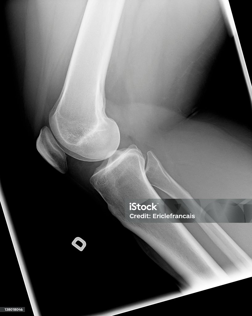 X-ray do joelho com Chondromalacia - Foto de stock de Articulação Humana - Termo anatômico royalty-free