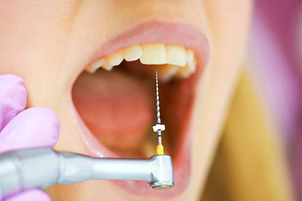 стоматологические лечения - mouth open human teeth doctor dental drill стоковые фото и изображения