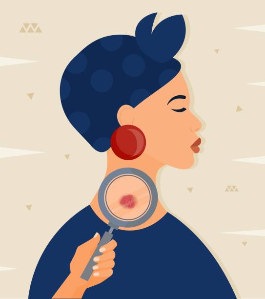 Dermatology and skin health care abstract concept Dermatology and skin health care abstract concept. Doctor hand with magnifying glass checks spots on dermis. Skin cancer, oncology or acne. Treatment of diseases. Cartoon flat vector illustrat. ion melanoma stock illustrations
