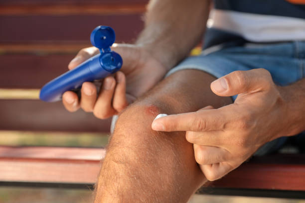 istock Man applying insect repellent cream on his leg outdoors, closeup 1380696481