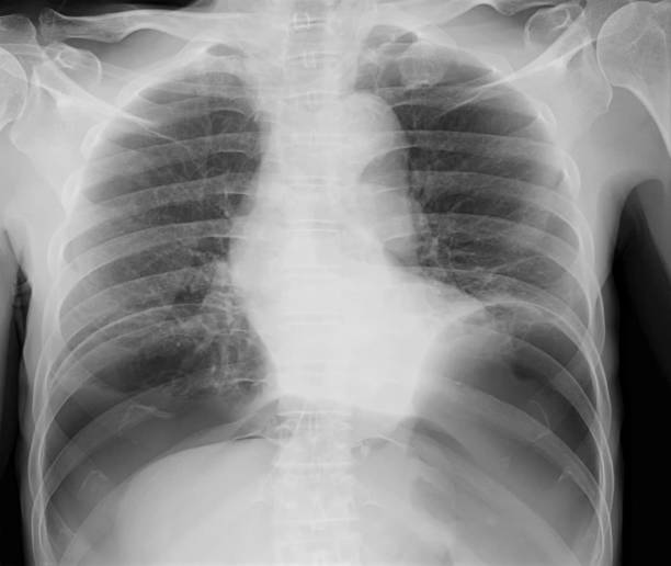 肺炎性ペリトリウム胸部x線 - pain rib cage x ray image chest ストックフォトと画像