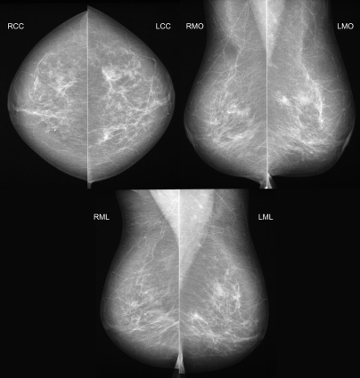Mammography in all 3 projections showing a slight parenchyma distortion with some tiny microcalcifications. This proved to be 1.5 cm ductal carcinoma.